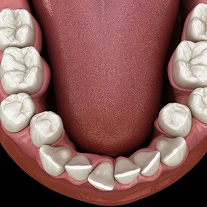 Illustration of crowded teeth