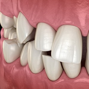 Illustration of gapped teeth