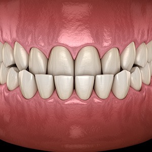 Illustration of an underbite