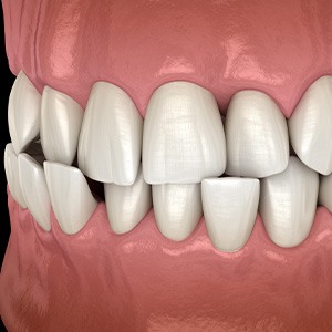 Illustration of a crossbite