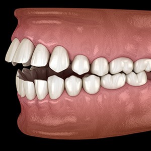 Illustration of an open bite
