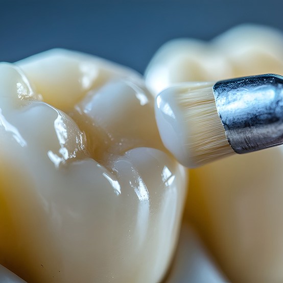 A brush applying a dental sealant to a back tooth